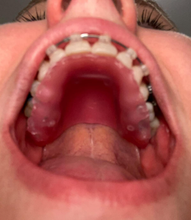 Load image into Gallery viewer, RPE Tongue Guard